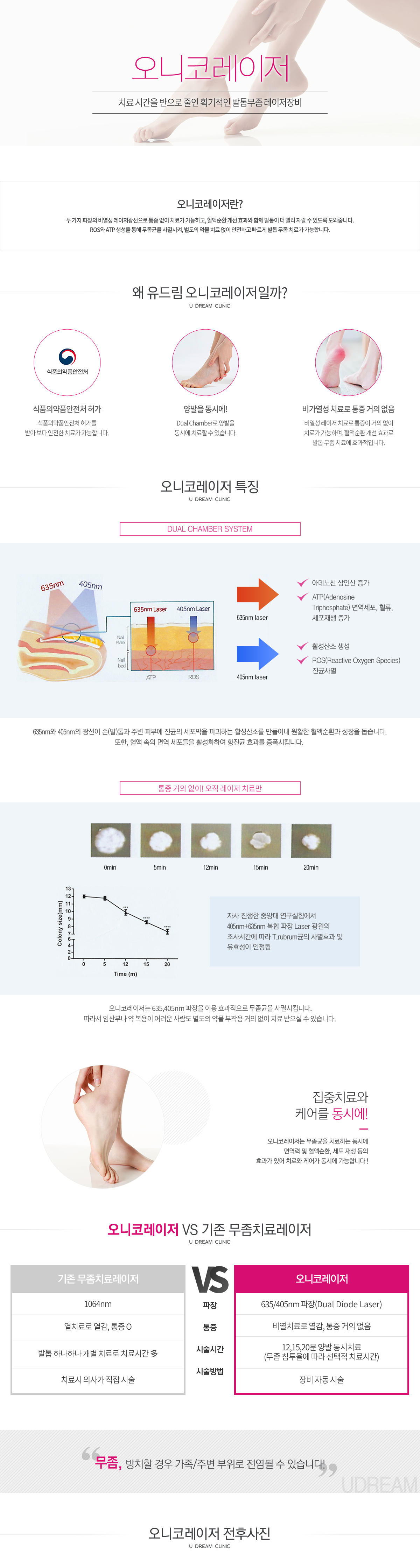 오니코레이저